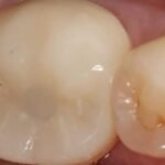 dental-crown-after-1