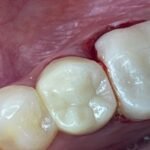 dental-crown-after-2