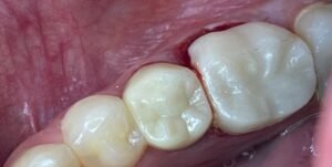 dental-crown-after-2
