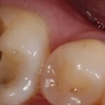 dental-crown-before-1