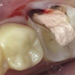 dental-crown-before-2