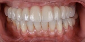 dental-implant-after-2
