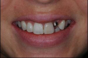 dental-implant-before-1