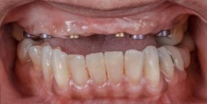 dental-implant-before-2