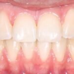 orthodontic-braces-after