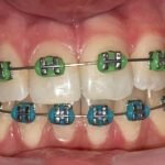 orthodontic-braces-before