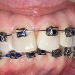 orthodontic-braces-before-2