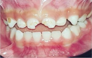 pediatric-dentistry-before-2