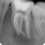 rootcanal-after