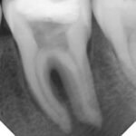 rootcanal-before