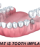 What is a Tooth Implant