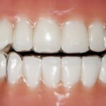 invi-aligners-1