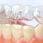 invi-aligners-2