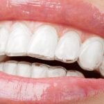 invi-aligners-3