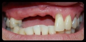 partial-denture-before-1