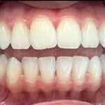 teeth-whitening-after-1