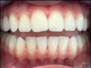 teeth-whitening-after-1