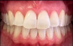 teeth-whitening-after-2