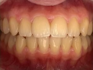 teeth-whitening-before-1