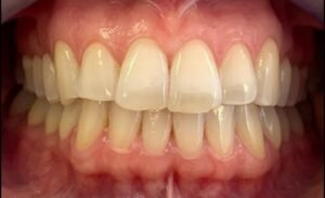 teeth-whitening-before-2