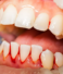 What You Need to Know About Bleeding Gums