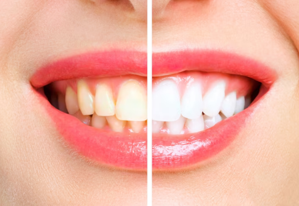 how much teeth whitening cost