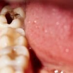 wisdom tooth extraction