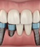 Dental Implant vs Bridge: Which Is Better for Replacing Missing Teeth?