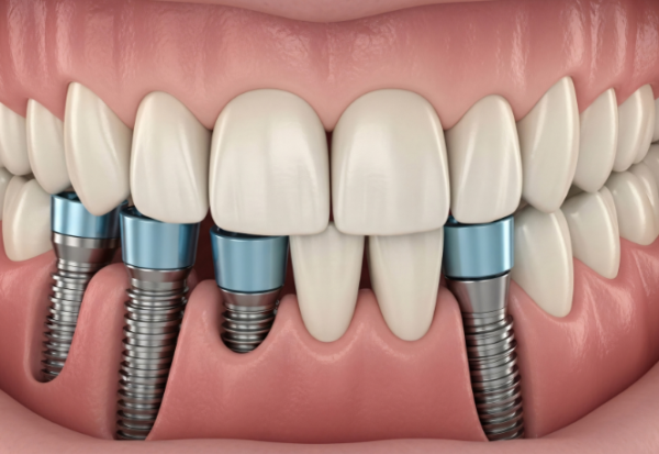 Dental Implants vs Bridge