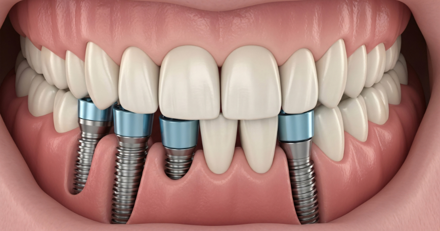 Dental Implants vs Bridge