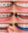 Types of Braces for Teeth: Which Option Is Right for You?