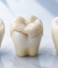 Dental Inlay vs Onlay: What’s the Difference and Which Do You Need?