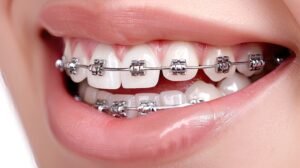 self ligating braces